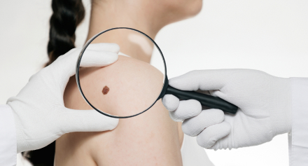Image representing Understanding Melanoma: When Should You Check Your Moles?